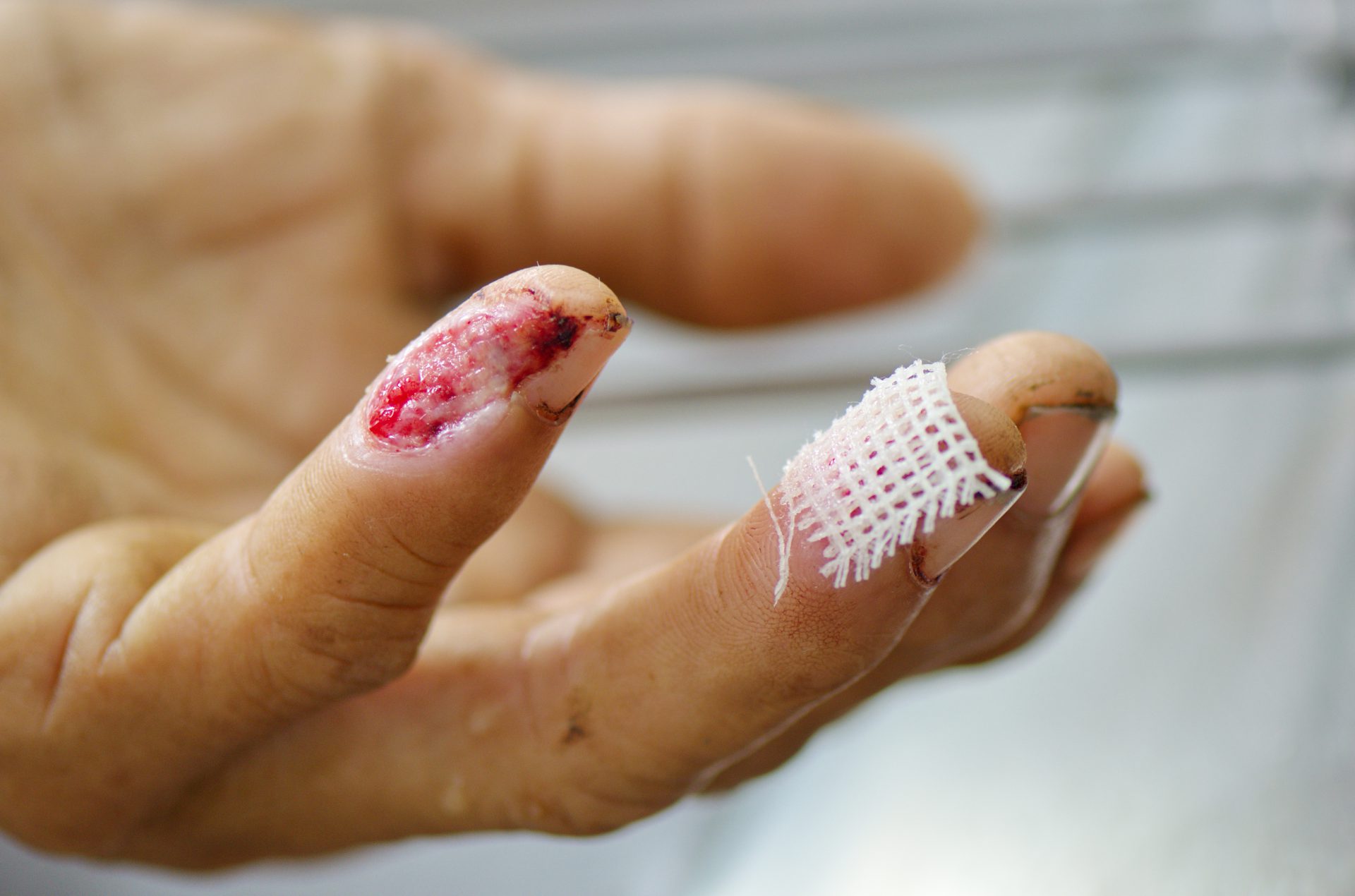 Uszkodzone palce w wyniku złego użytkowania petard.
