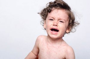 Ognisko odry w Polsce. Epidemia zbliża się wielkimi krokami!