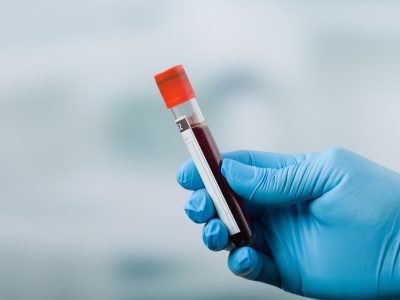 Probówka zawierająca krew przeznaczona do badań laboratoryjnych.