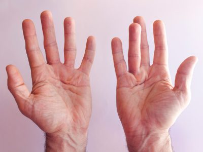 Przykurcz Dupuytrena - choroba rozcięgna dłoniowego.