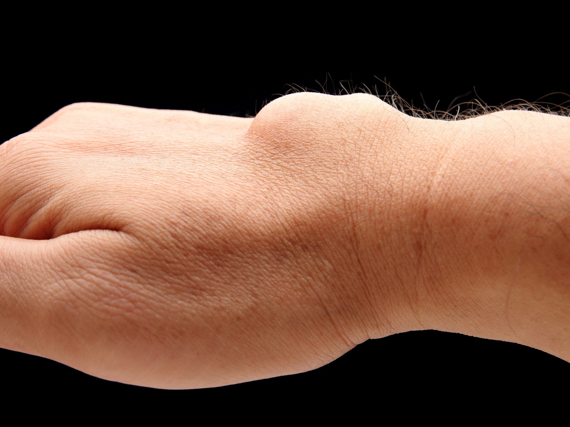 Ręka mężczyzny przedstawiająca ganglion - bolesny guzek na nadgarstku.