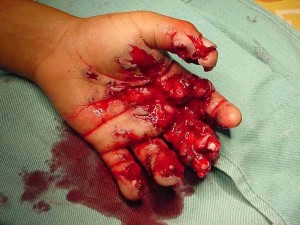 szpital chirurgii jednego dnia uszkodzona ręka
