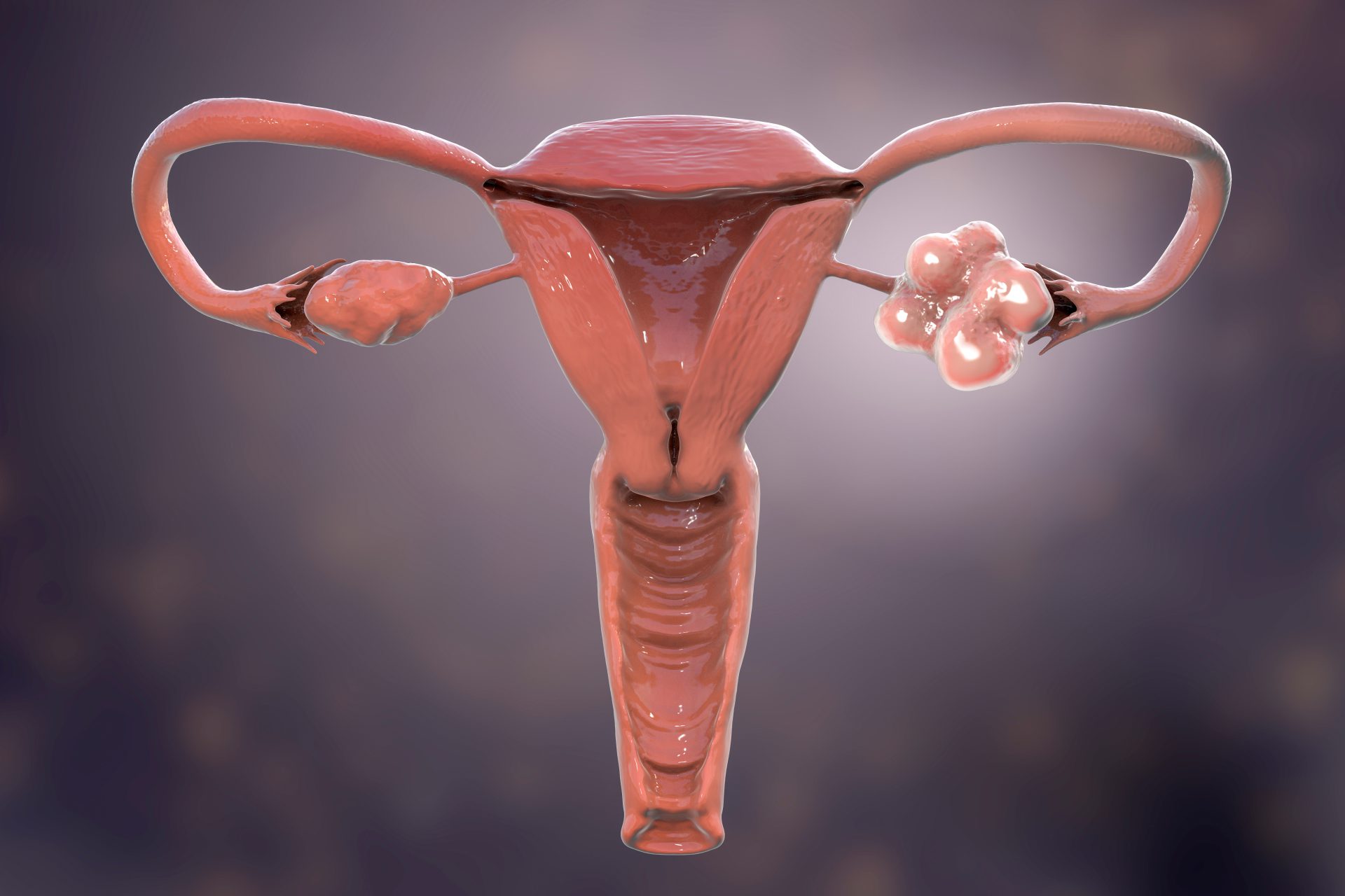 Obraz 3D - zespół policystycznych jajników (PCOS), a problemy z zajściem w ciąże