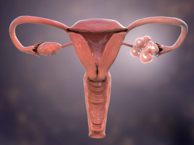 Obraz 3D - zespół policystycznych jajników (PCOS), a problemy z zajściem w ciąże